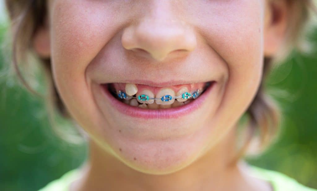 5 Reasons Parents Choose Orthodontic Treatment for Kids Along with Dental Implants Houston, TX Services