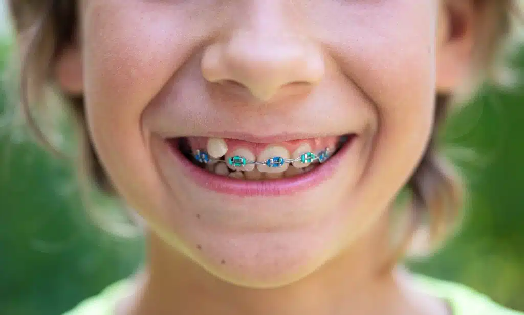 5 Reasons Parents Choose Orthodontic Treatment for Kids Along with Dental Implants Houston, TX Services 5 Reasons Parents Choose Orthodontic Treatment for Kids Along with Dental Implants Houston, TX Services