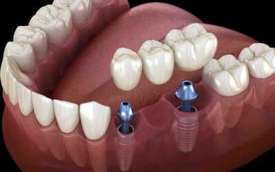 Teeth Whitening – Simple Steps Toward a Beautiful Smile