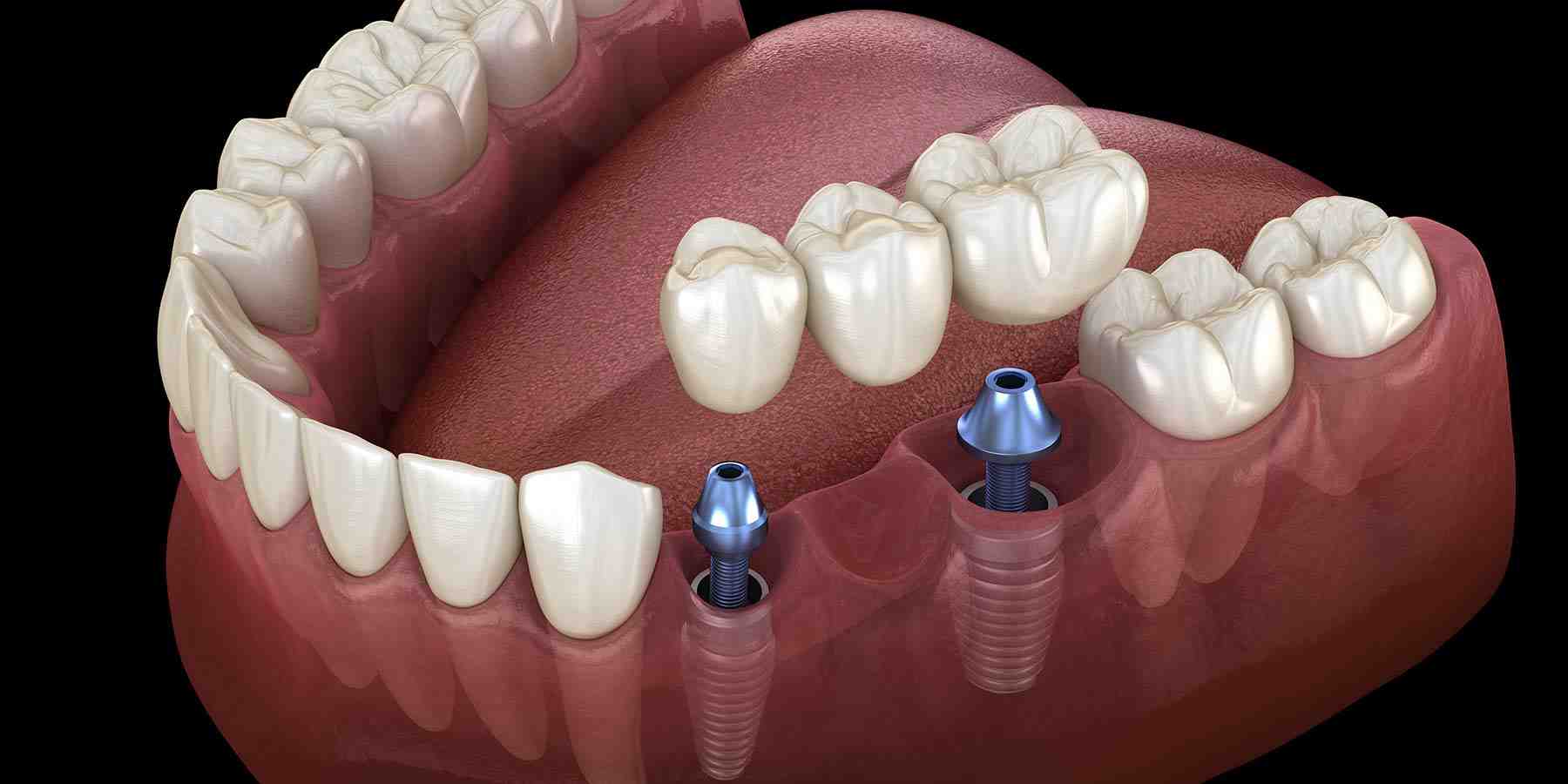 Teeth Whitening – Simple Steps Toward a Beautiful Smile Teeth Whitening - Simple Steps Toward a Beautiful Smile
