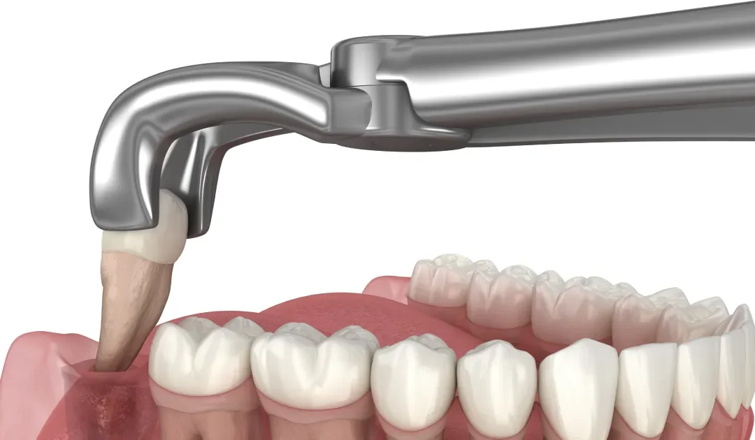 Understanding Outpatient Oral Surgery Wisdom Teeth Procedures and Recovery