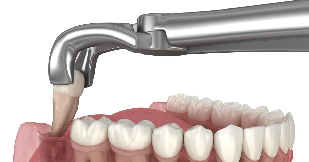Understanding Outpatient Oral Surgery Wisdom Teeth Procedures and Recovery Understanding Outpatient Oral Surgery Wisdom Teeth Procedures and Recovery