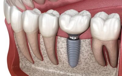 Are You a Candidate for Dental Implants? Key Factors Houston Dentists Look For