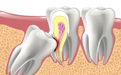 Wisdom Teeth Removal in Houston: A Guide to Safe and Effective Extraction