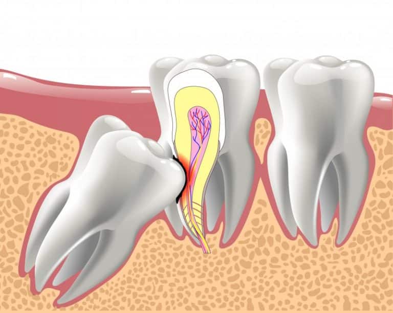 Wisdom Teeth Removal in Houston: A Guide to Safe and Effective Extraction